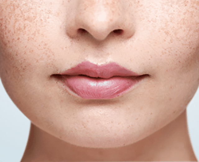 Close up of a woman with no visible cold sore on her lip | Une femme sans feu sauvage sur les lèvres